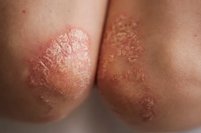 Understanding Psoriasis Symptoms, Causes, and Types