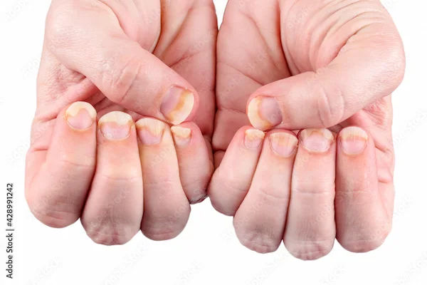 Know all about Nail Infections: Signs, Causes and Risk Factors.