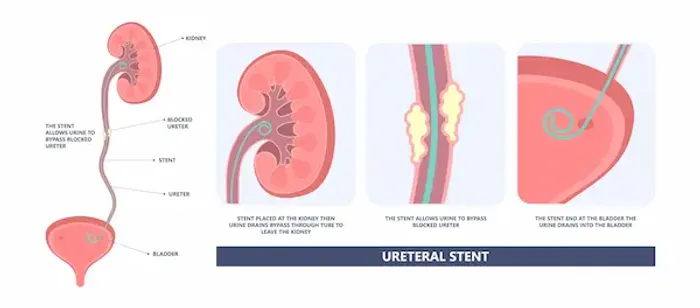 Ureteral Obstruction