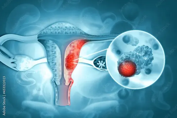 Ovarian Cancer