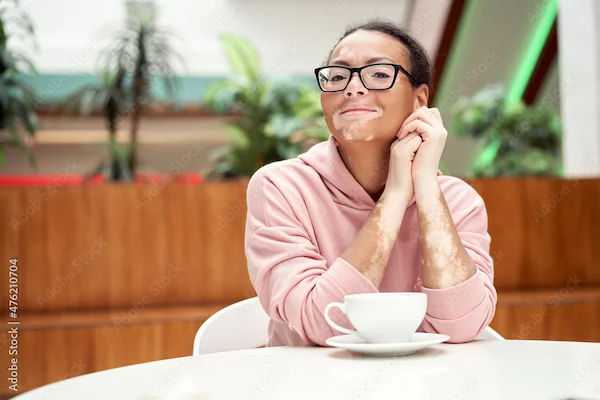 Understanding Vitiligo: Causes, Signs, and Different Types