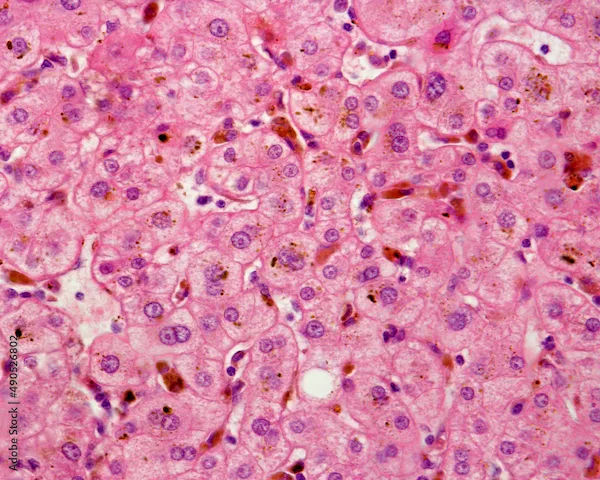 Cholestasis Overview: Symptoms, Causes, and Treatment
