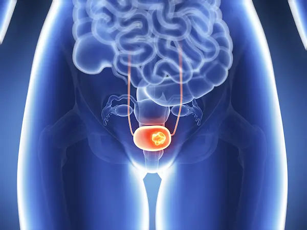 Bladder Cancer