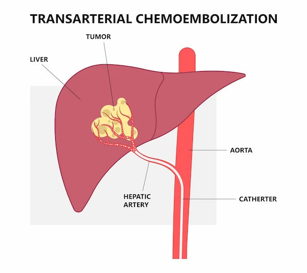 Guide to Tace Transarterial Chemoembolization
