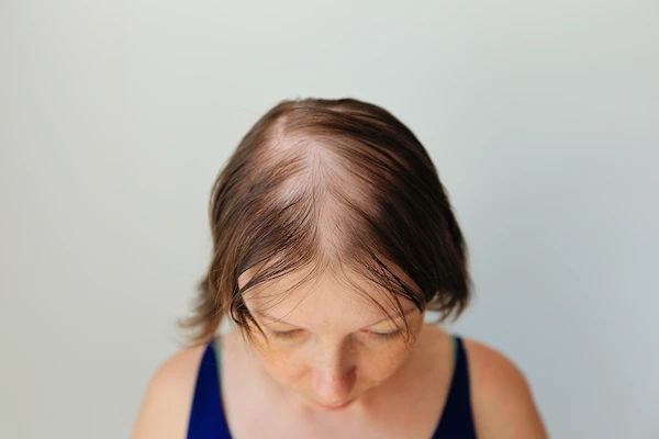 hair loss