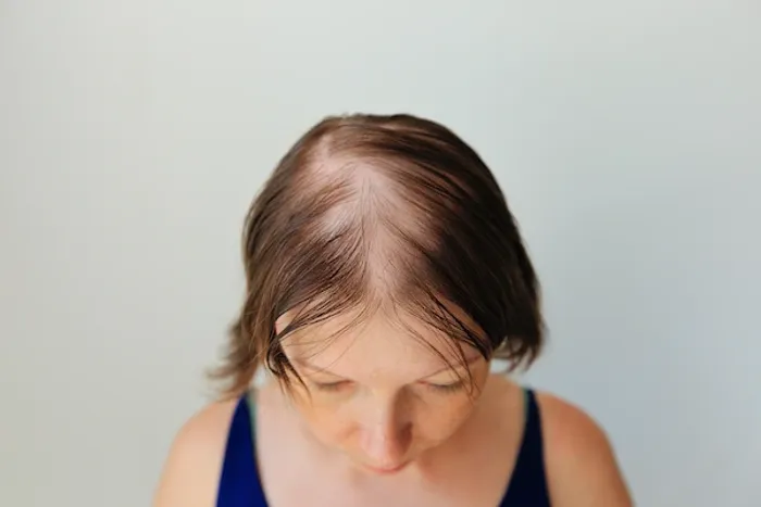 hair loss
