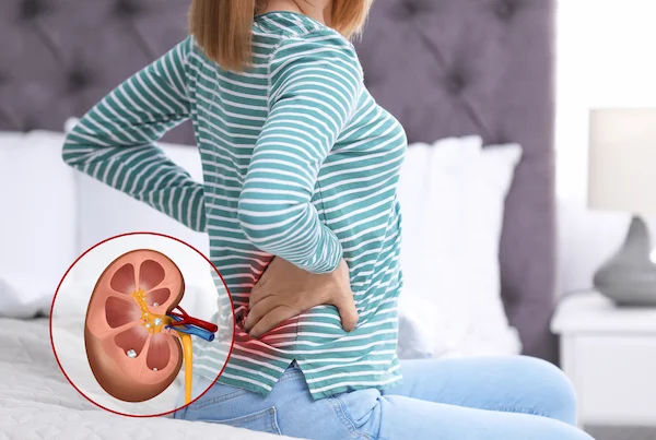 Kidney Stone Pain in Summer: Why It Strikes More Often