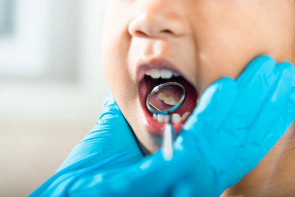 Dental Cavities in Very Young Children