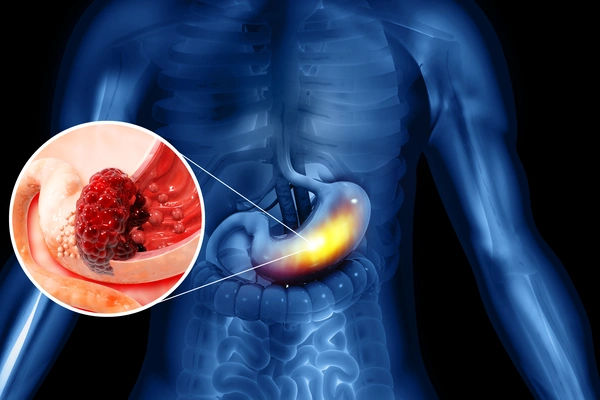 stomach cancer