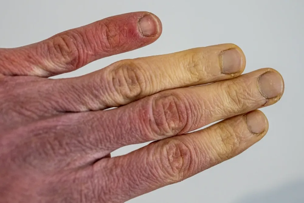 vibration induced white finger Manifesting as tingling and numbness through to manual dexterity loss and  dreaded Vibration White Finger (VWF) / Hand-Arm Vibration Syndrome (HAVS),  both secondary forms of Raynaud's syndrome, where vibration-induced  spasming of small main image 1