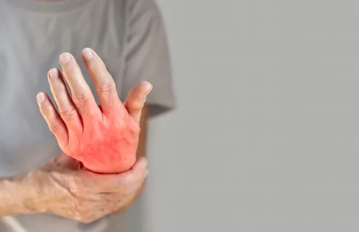 Arthritis Diagnosed