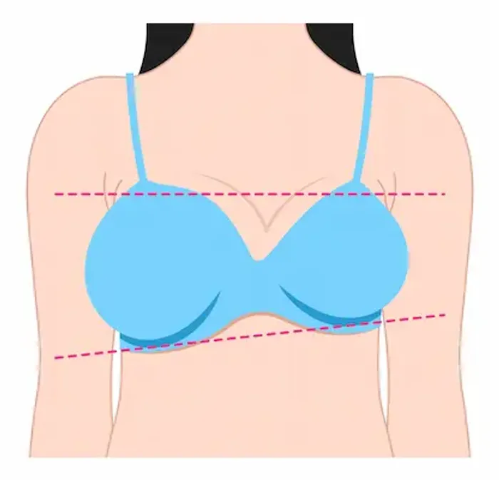 Tuberous Breast Deformity Ruin Your Life