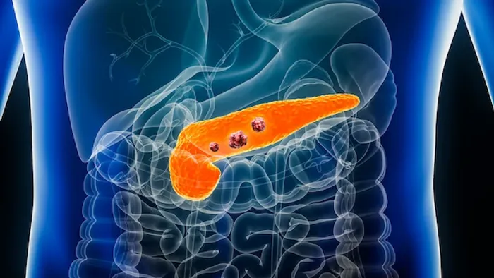 pancreatic cancer