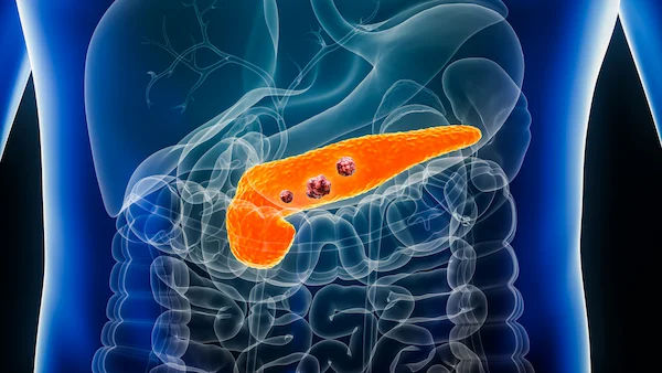 Causes and Risk Factors of Pancreatic Cancer