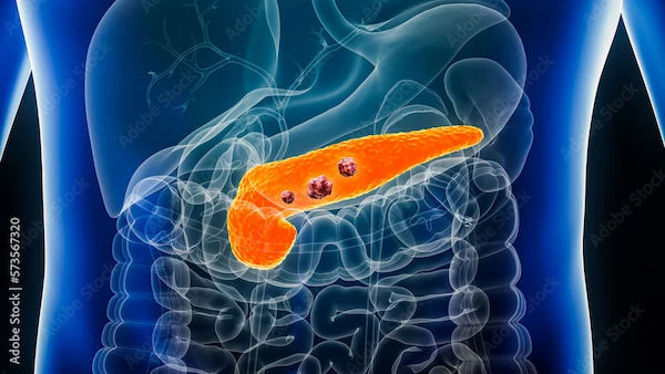 ​What Leads to Pancreatic Cancer? Causes & Risk Factors