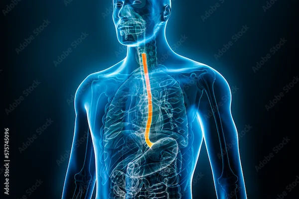 Barrett's Esophagus Overview: Symptoms, Causes, Treatments