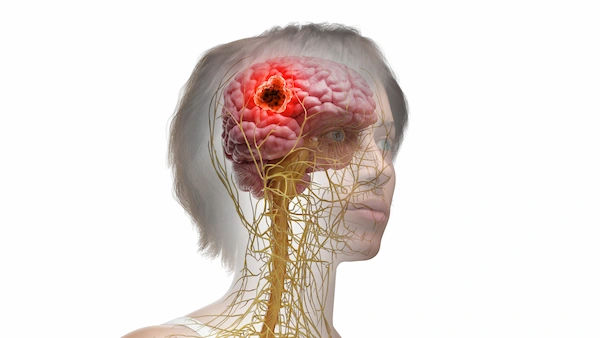 brain tumour