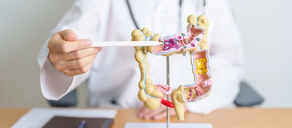 colon cancer
