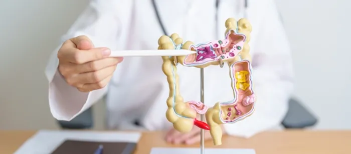 colon cancer