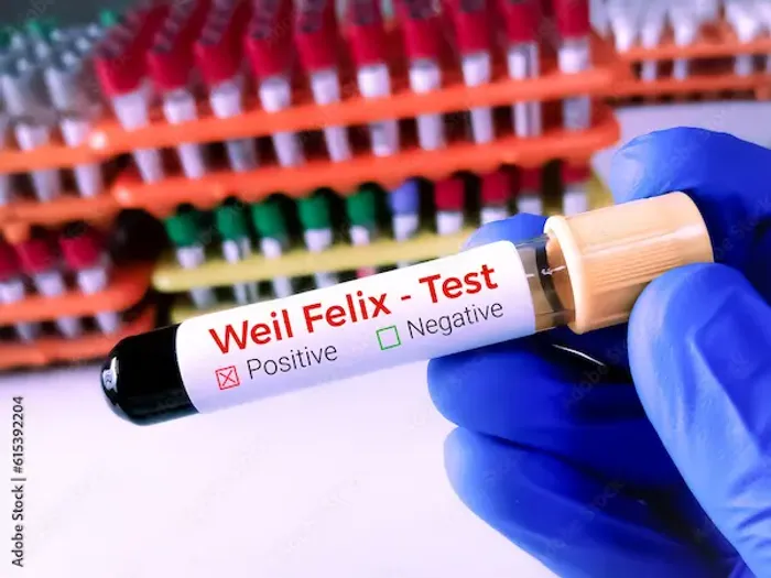 Weil Felix Test Normal Range