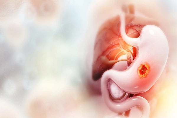 stomach ulcer