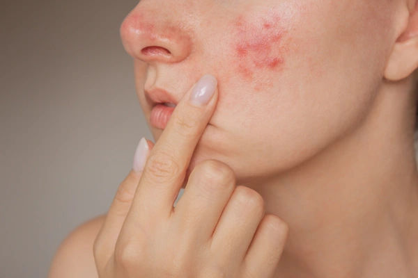 rosacea