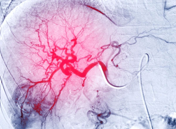Transarterial Chemoembolization (TACE)