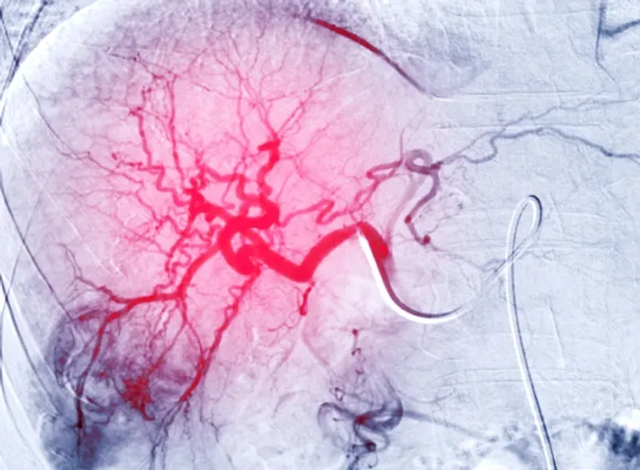 Transarterial Chemoembolization (TACE)