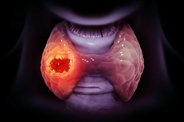 thyroid cancer