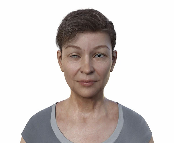 horner syndrome