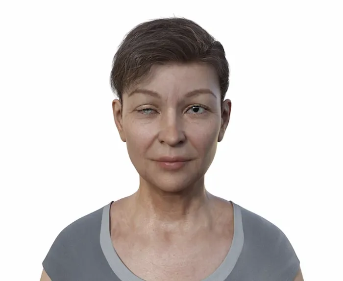 horner syndrome