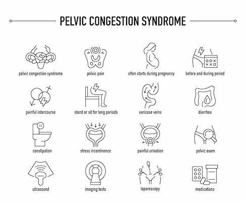 Pelvic Congestion Syndrome Common Undiagnosed Condition