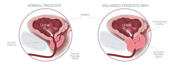 Enlarged Prostate