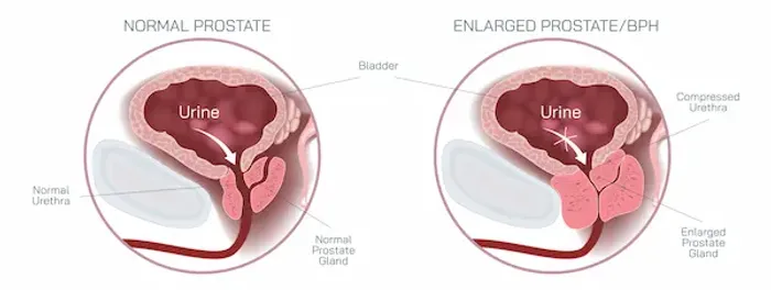 Enlarged Prostate