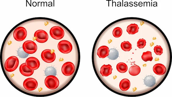 Thalassaemia Testing and Its Screening Importance