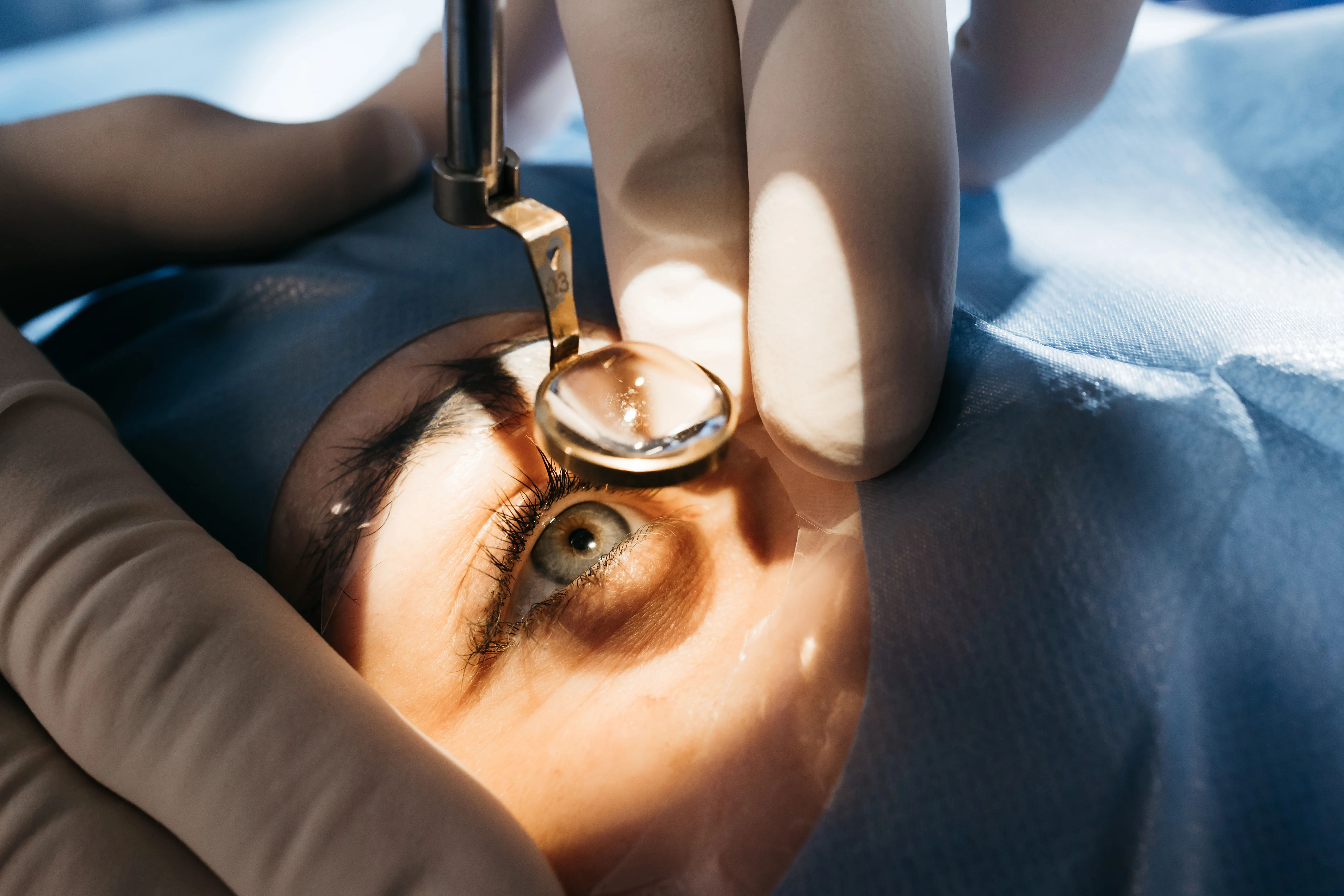 Understanding Cataract Surgery  Introduction