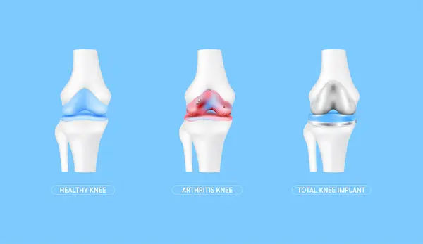 Guide to Myths And Facts Total Knee Replacement Tkr