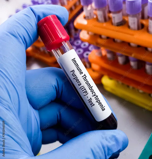 Understanding Immune Thrombocytopenic Purpura (ITP): Symptoms, Causes, and Care
