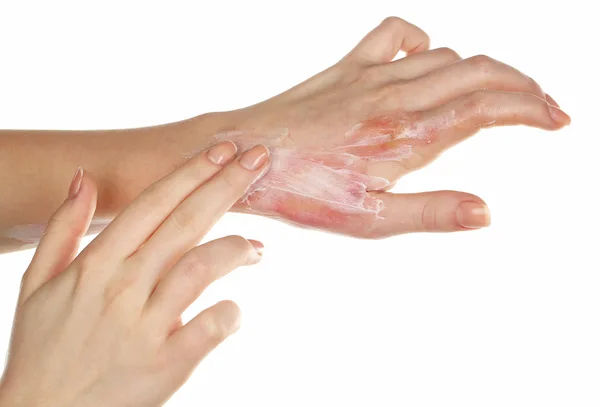 Guide to First Aid For Burns Caution Actions Home Care