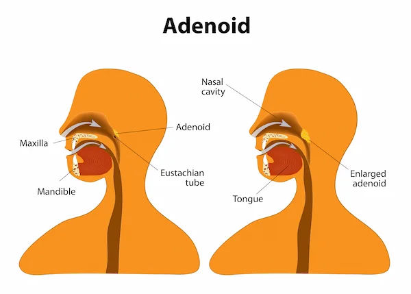 Understanding Adenoidectomy