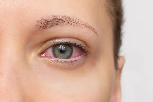 Uveitis