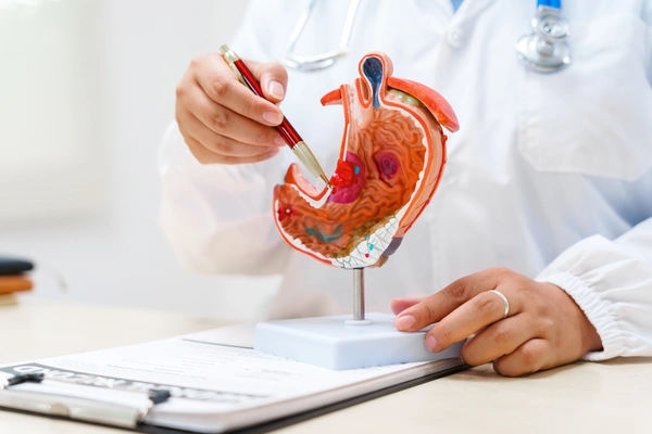 stomach cancer