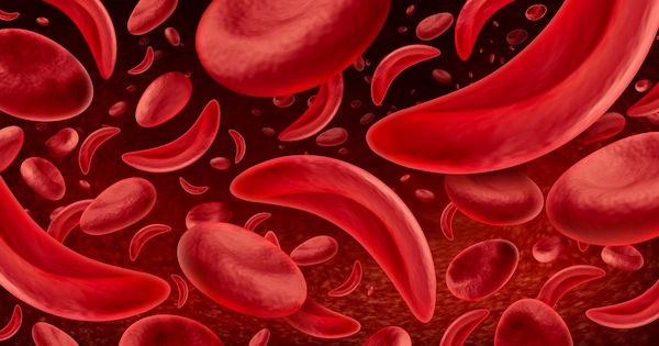 Understanding Bone Marrow Transplant for Sickle Cell Disease