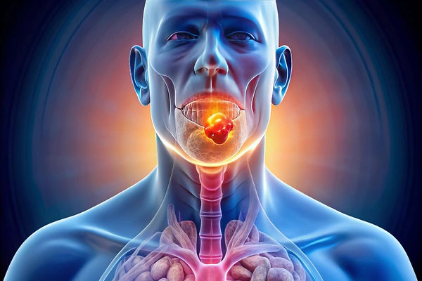 neck cancer