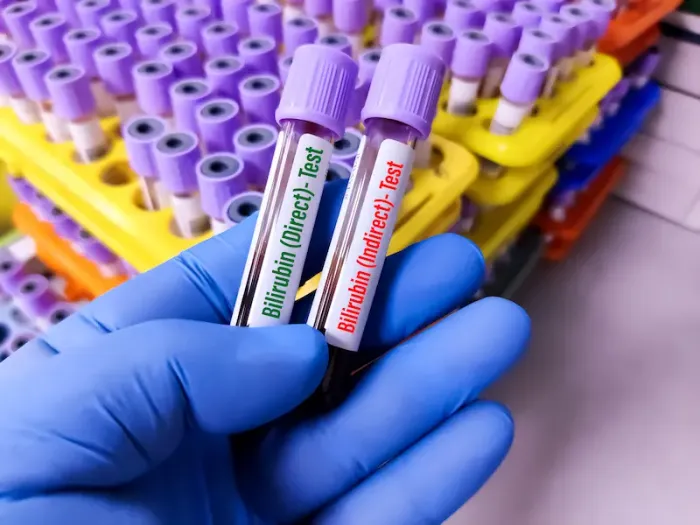 Bilirubin Test Normal Range A Complete Guide