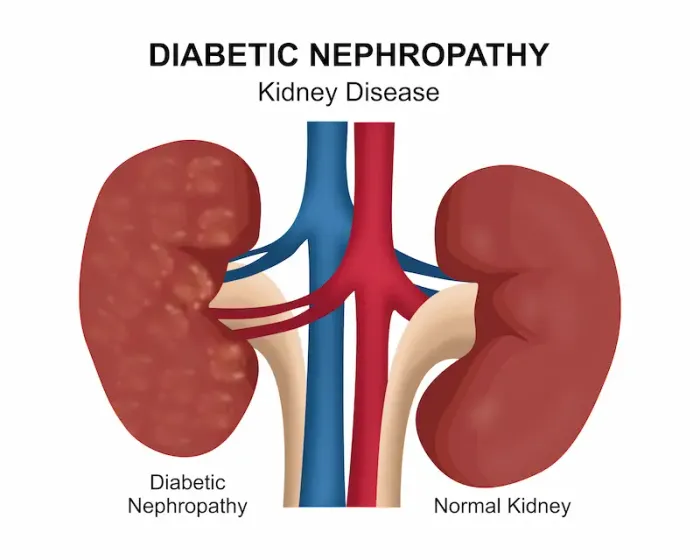 Guide to Diabetes Nephropathy Kidney Disease