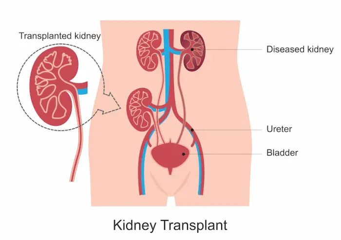 Guide to Kidney Transplant Recovery