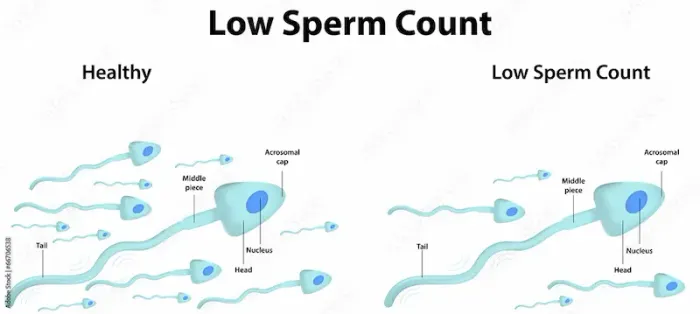Low Sperm Count Causes and Treatment
