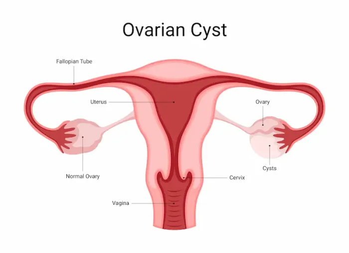 Ovarian Cyst Symptoms, Diagnosis, and Treatment
