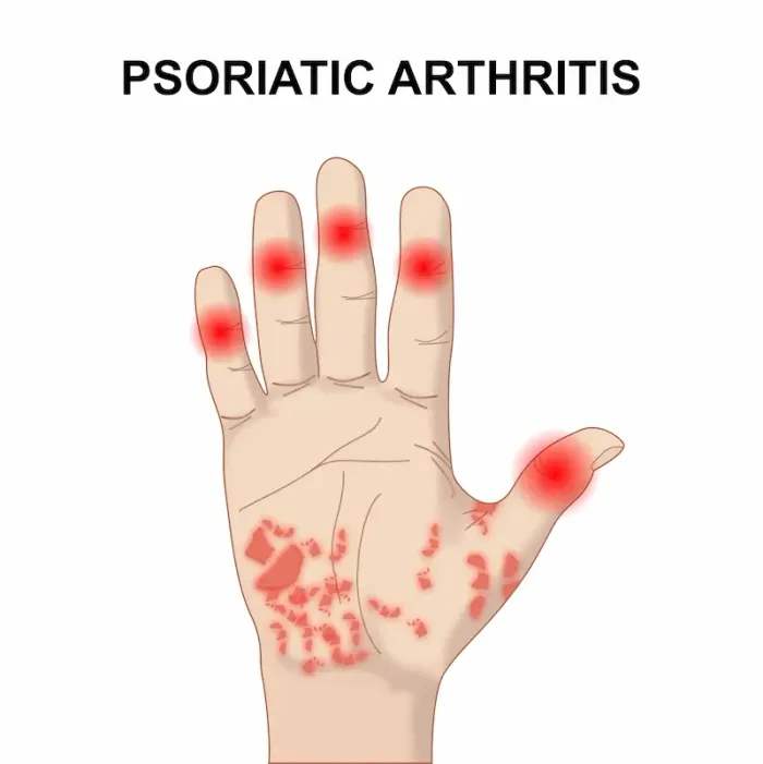 Psoriatic Arthritis Overview of Symptoms and Treatment